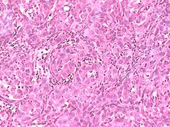 CA PIEL EPIDERMOIDE CA PIEL EPIDERMOIDE